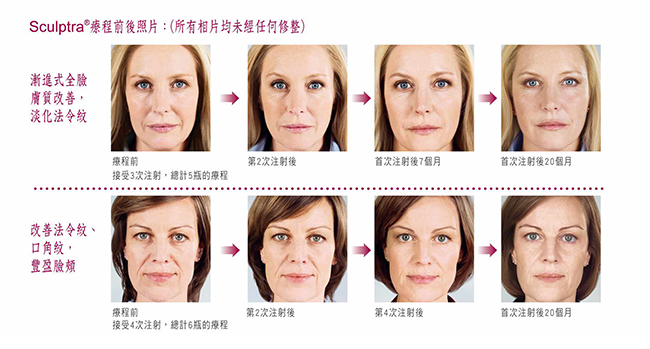 Sculptra舒顏萃