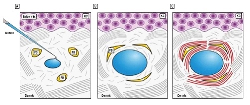 玻尿酸 鼻子 山根 法令紋 淚溝 下巴 玻尿酸 鼻子 山根 法令紋 淚溝 下巴