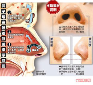 2016.11.15 / 蘋果日報報導 廖國良醫師 真害人 隆鼻神器險爛鼻致命