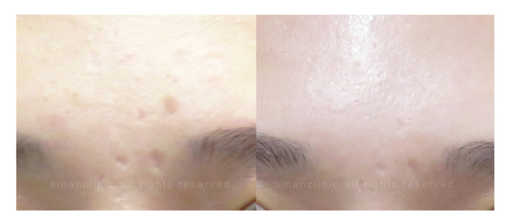 M22光梭雷射 M22光梭雷射