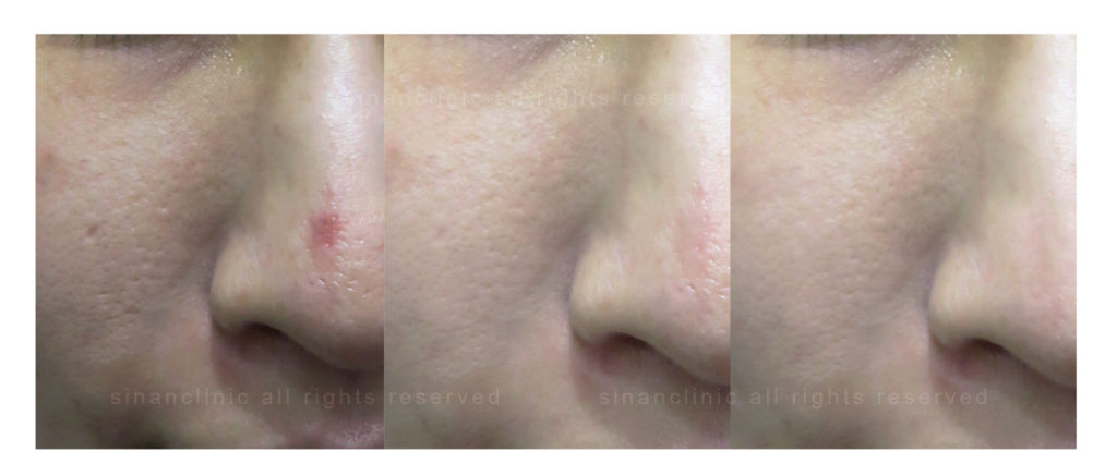 M22光梭雷射 M22光梭雷射