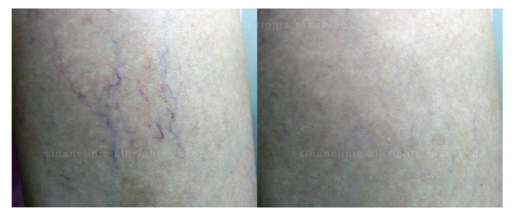 M22光梭雷射 M22光梭雷射