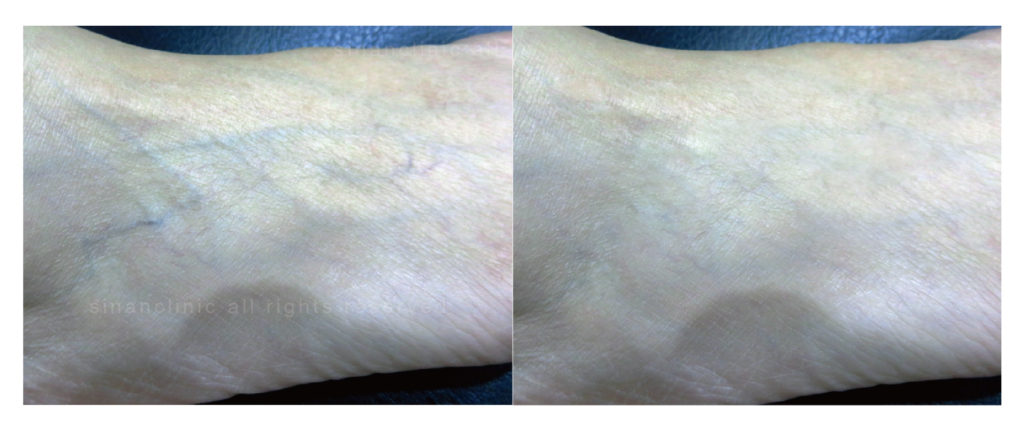 M22光梭雷射 M22光梭雷射