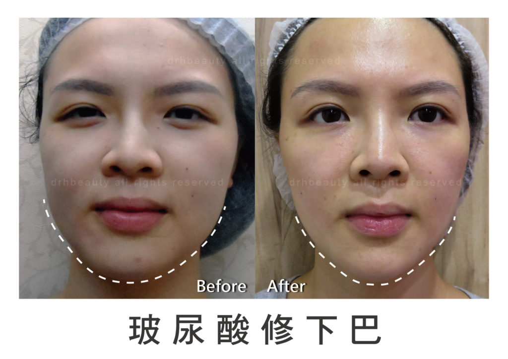 玻尿酸 鼻子 山根 法令紋 淚溝 下巴 玻尿酸 鼻子 山根 法令紋 淚溝 下巴