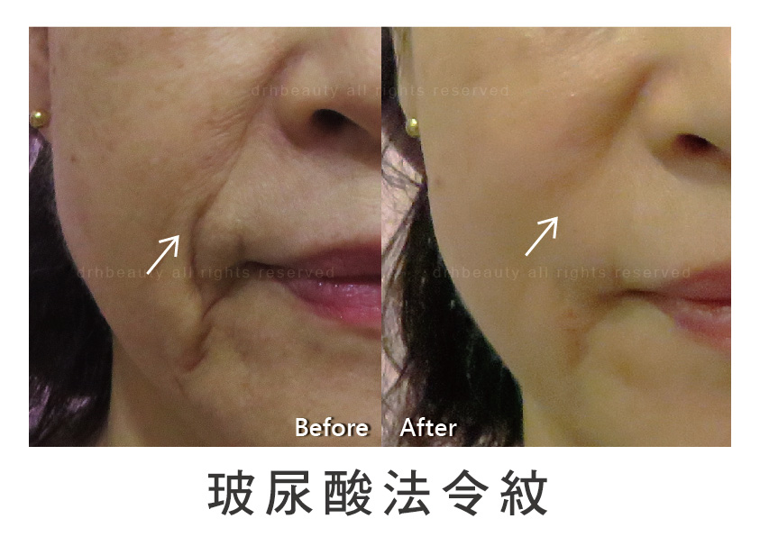 玻尿酸 鼻子 山根 法令紋 淚溝 下巴 玻尿酸 鼻子 山根 法令紋 淚溝 下巴