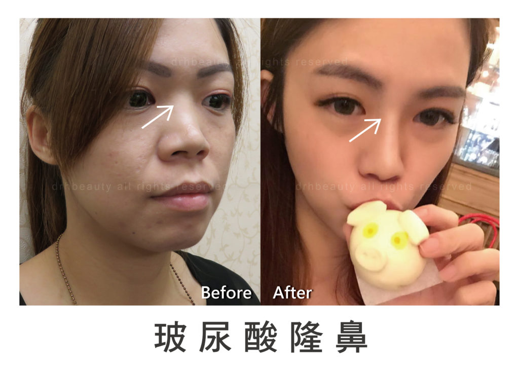 玻尿酸 鼻子 山根 法令紋 淚溝 下巴