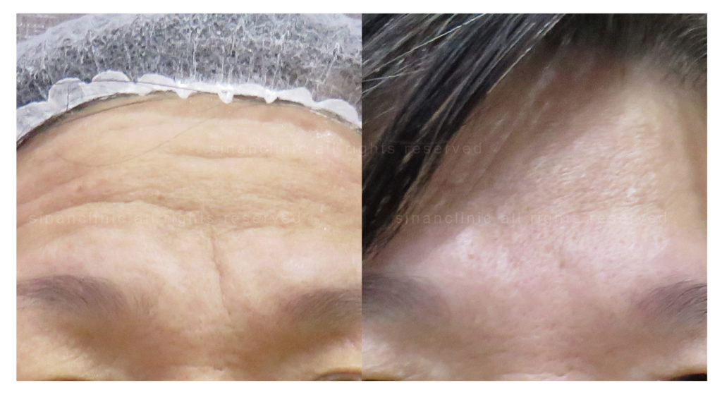 台北-肉毒桿菌-肉毒瘦小臉-肉毒除皺-皺紋-瘦臉-醫美-注射-微整形-玻尿酸-抬頭紋-細紋-魚尾紋-法令紋-南港-推薦