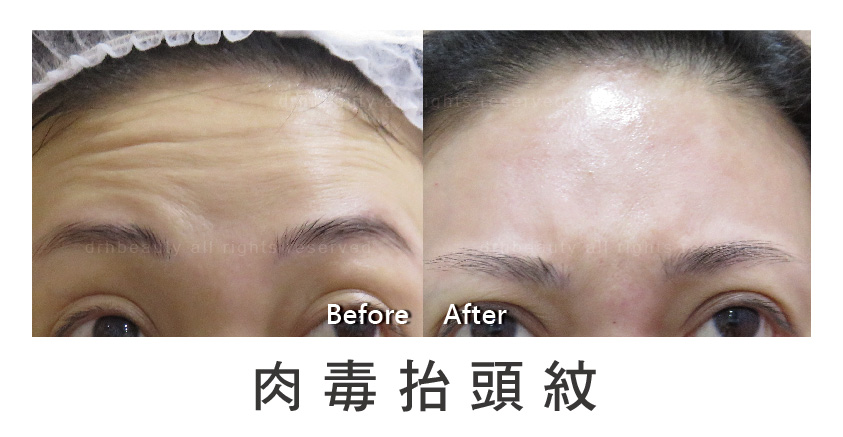 台北-肉毒桿菌-肉毒瘦小臉-肉毒除皺-皺紋-瘦臉-醫美-注射-微整形-玻尿酸-抬頭紋-細紋-魚尾紋-法令紋-南港-推薦 台北-肉毒桿菌-肉毒瘦小臉-肉毒除皺-皺紋-瘦臉-醫美-注射-微整形-玻尿酸-抬頭紋-細紋-魚尾紋-法令紋-南港-推薦