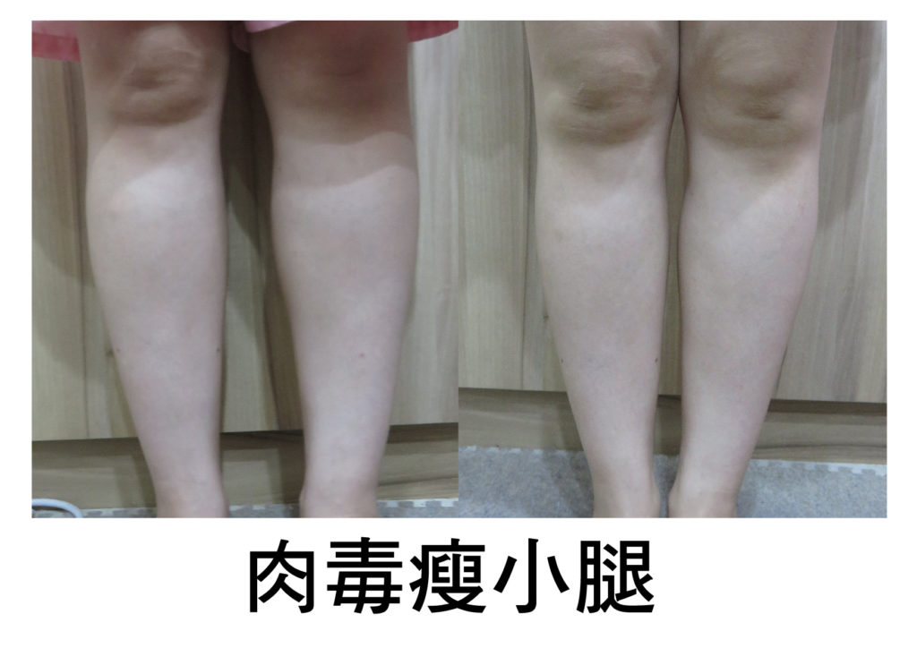 台北-肉毒桿菌-肉毒瘦小臉-肉毒除皺-皺紋-瘦臉-醫美-注射-微整形-玻尿酸-抬頭紋-細紋-魚尾紋-法令紋-南港-推薦