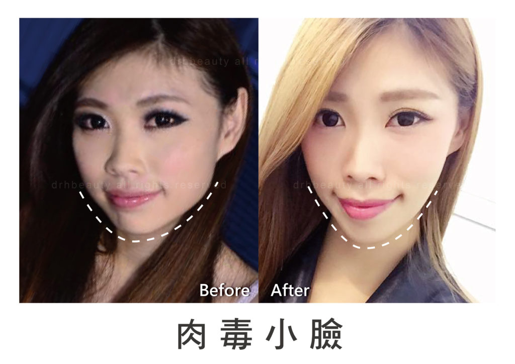 台北-肉毒桿菌-肉毒瘦小臉-肉毒除皺-皺紋-瘦臉-醫美-注射-微整形-玻尿酸-抬頭紋-細紋-魚尾紋-法令紋-南港-推薦 台北-肉毒桿菌-肉毒瘦小臉-肉毒除皺-皺紋-瘦臉-醫美-注射-微整形-玻尿酸-抬頭紋-細紋-魚尾紋-法令紋-南港-推薦