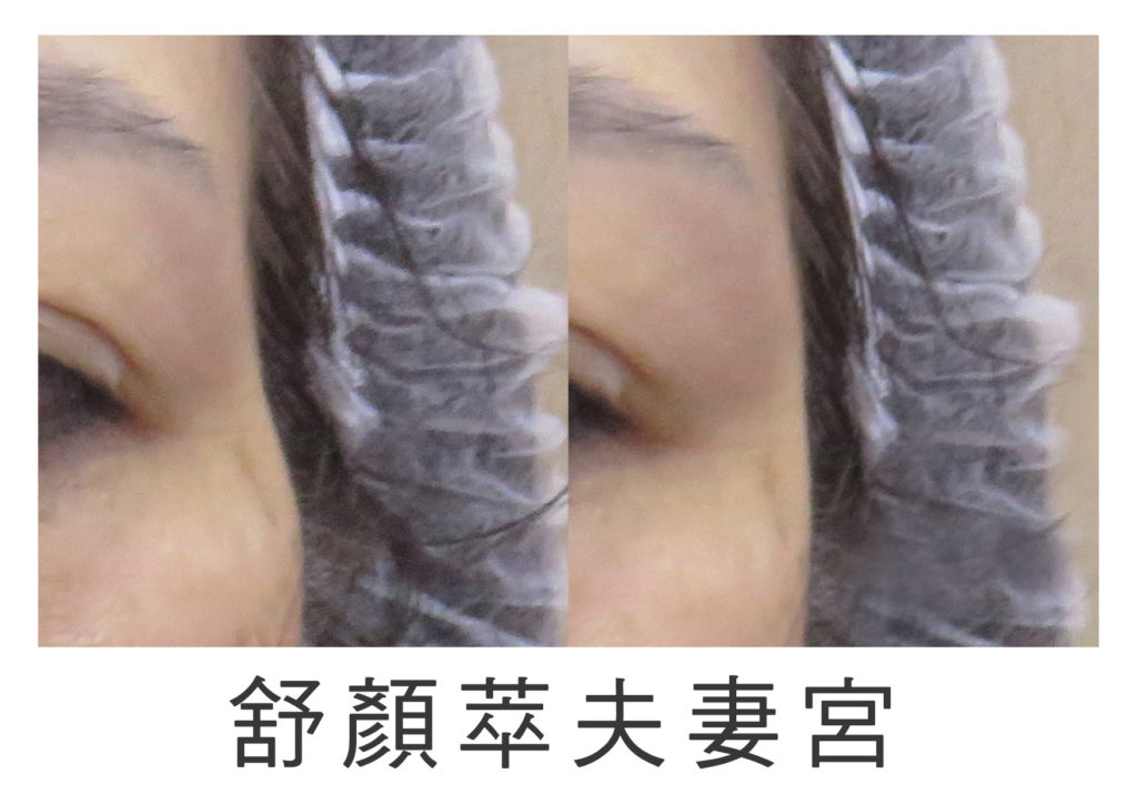 3D聚左旋乳酸sculptra 3D聚左旋乳酸sculptra