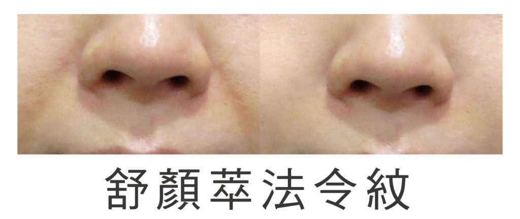 3D聚左旋乳酸sculptra