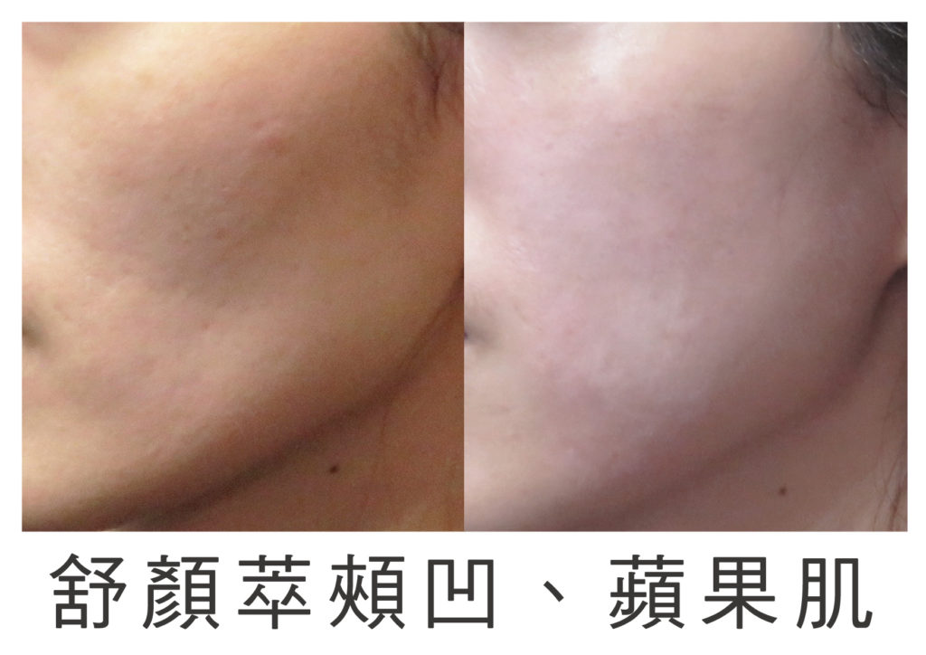 3D聚左旋乳酸sculptra 3D聚左旋乳酸sculptra