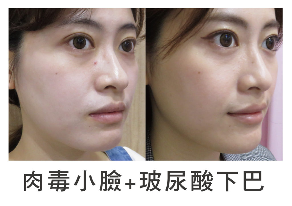 台北-肉毒桿菌-肉毒瘦小臉-肉毒除皺-皺紋-瘦臉-醫美-注射-微整形-玻尿酸-抬頭紋-細紋-魚尾紋-法令紋-南港-推薦