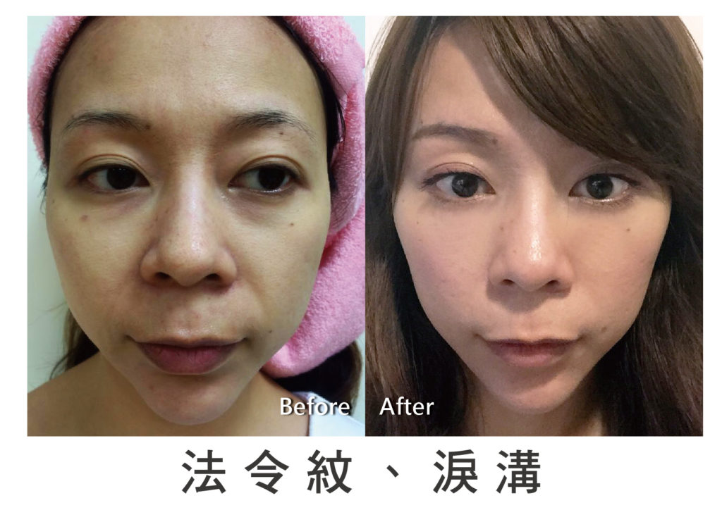 玻尿酸 鼻子 山根 法令紋 淚溝 下巴 玻尿酸 鼻子 山根 法令紋 淚溝 下巴