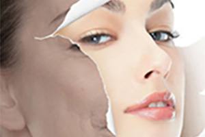 杏仁酸煥膚 護理及注意事項