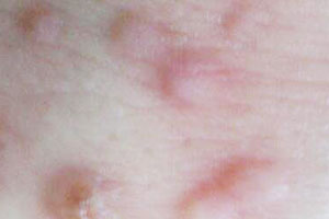 尋常疣(魚鱗贅，雞眼)