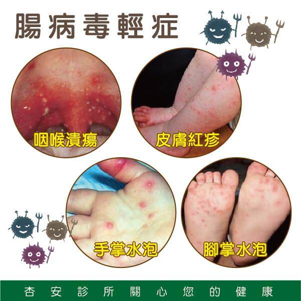 腸病毒症狀及預防方法 吳忠展醫師為您解說 腸病毒症狀及預防方法 吳忠展醫師為您解說