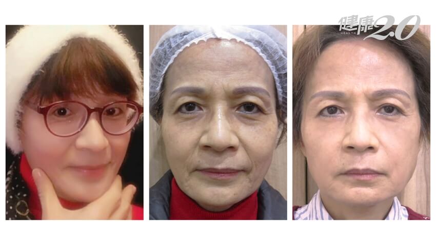 [TVBS報導]不怕被說「照騙」！「P圖」微整型正夯