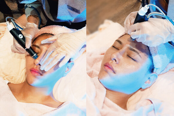 南港 HydraFacial海菲秀推薦 改善臉頰粉刺、痘痘