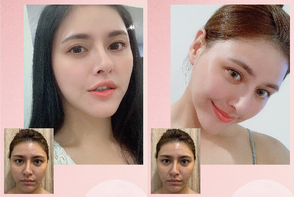 南港 HydraFacial海菲秀推薦 改善臉頰粉刺、痘痘