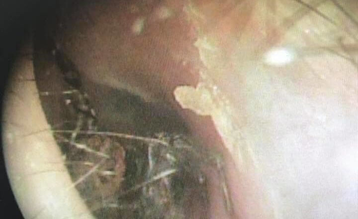 耳裡的盤絲洞 杏安診所