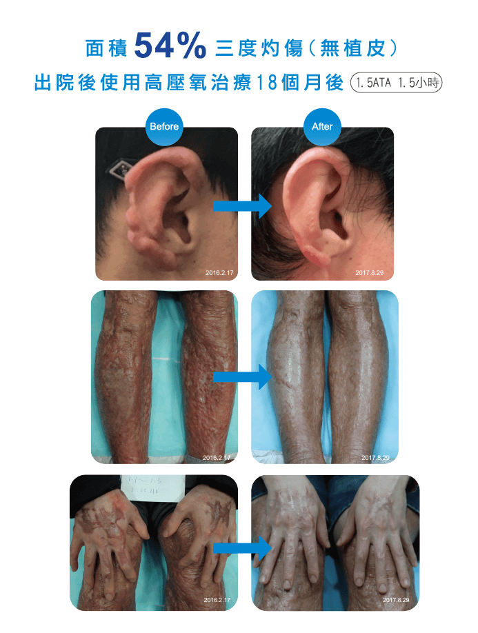 美帝可耐高壓氧艙(HBOT)