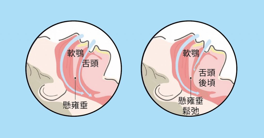 🛏️ 枕邊人吵得睡不著?您的打鼾聲,可能不只是噪音 您是否也有這樣的困擾?明明累了一天,晚上卻因為自己的鼾聲(或伴侶的鼾聲)而無法安睡?打鼾不僅影響睡眠品質,更可能是「睡眠呼吸中止症」的警訊,長期下來對心血管健康是一大威脅。 傳統上,處理打鼾可能需要配戴呼吸器或進行疼痛感較強的外科手術。但現在,您有更輕鬆、更有效的新選擇。荃威診所引進先進的醫療技術——「止鼾雷射」,提供一個非侵入性、低疼痛感的治療方案,幫助您從根本改善問題。