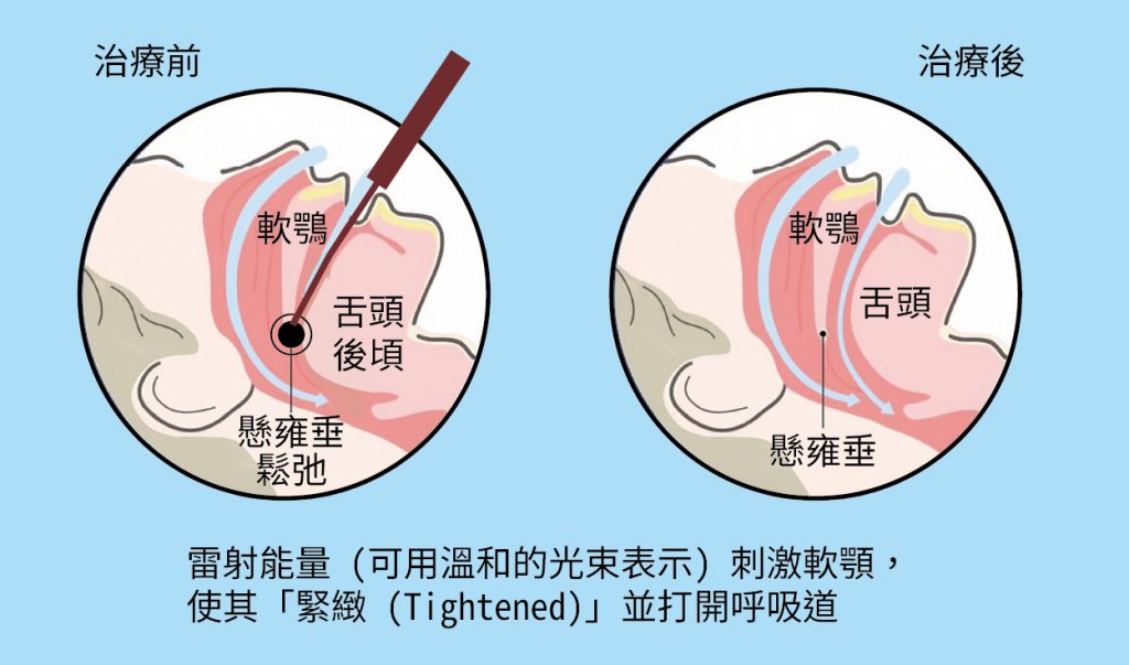 💡 深入了解「止鼾雷射」:使用者最想問的 3 大問題 當使用者在 Google 搜尋「止鼾雷射」時,他們心中充滿了疑問。荃威診所專業團隊為您一次釐清: 1. 「止鼾雷射是什麼?原理是?」 許多人對「雷射」感到陌生或恐懼。「止鼾雷射」(又稱作 Fotona NightLase®)是一種非侵入性的治療。 荃威診所採用的止鼾雷射,是利用特定波長的雷射光能量,溫和地加熱口腔內(特別是軟顎和懸雍垂)的黏膜組織。這個過程會刺激膠原蛋白新生與重組,使鬆弛的組織變得更為緊緻、有彈性。 簡單來說,就像用雷射幫鬆弛的呼吸道「拉提」一樣。當呼吸通道被打開,空氣流通順暢,就能大幅減少因組織震動而產生的鼾聲。